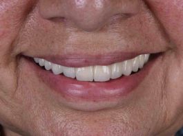 Diseño de sonrisas:  Un tratamiento para recuperar la autoestima