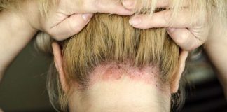 Psoriasis, una enfermedad crónica de la piel que impacta la calidad de vida y se ve perjudicada por el exceso de sol