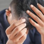 ¡Chile ocupa el Top 3 en el ranking de calvicie en Latinoamérica! Causas y cómo prevenir la caída del cabello