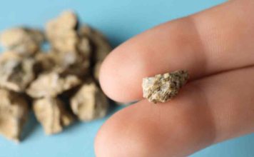 Verano: aumentan ataques de cálculos renales  Verano: aumentan ataques de cálculos renales