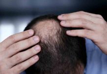 La autoestima de los hombres que se esfuma con la pérdida de cabello