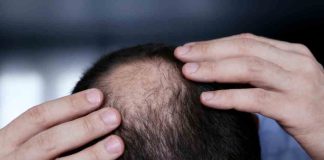 La autoestima de los hombres que se esfuma con la pérdida de cabello