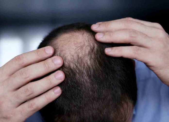 La autoestima de los hombres que se esfuma con la pérdida de cabello La autoestima de los hombres que se esfuma con la pérdida de cabello