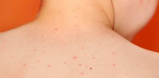 Piojos, verrugas y moluscos contagiosos: Cómo enfrentar a los intrusos del verano