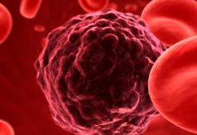 Día Mundial del Cáncer: innovadores tratamientos para mieloma múltiple son más eficaces y mejoran la calidad de vida de los pacientes