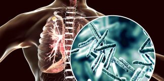 Día Mundial de la Tuberculosis: la visibilización de esta enfermedad no erradicada