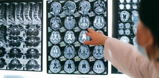 En 22% creció la incidencia de accidentes cerebrovasculares en 2024 en clínicas chilenas