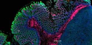 Investigadores de Mayo Clinic identifican proteínas relacionadas con la resistencia a la inmunoterapia en el cáncer colorrectal metastásico