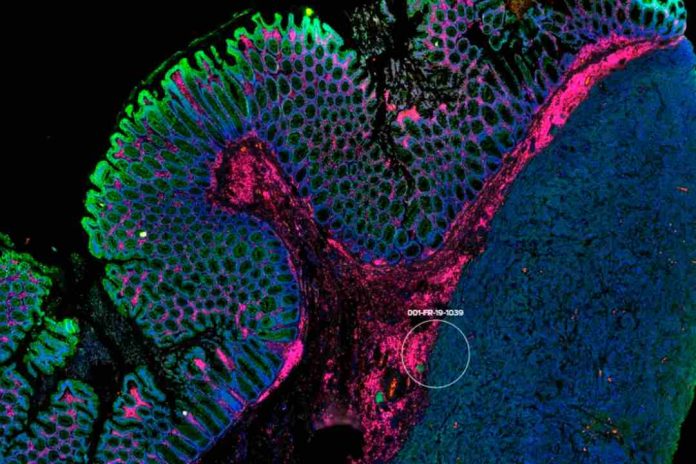 Investigadores de Mayo Clinic identifican proteínas relacionadas con la resistencia a la inmunoterapia en el cáncer colorrectal metastásico Investigadores de Mayo Clinic identifican proteínas relacionadas con la resistencia a la inmunoterapia en el cáncer colorrectal metastásico
