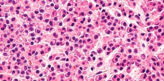 Mieloma Múltiple: avances en tratamientos y la necesidad de opciones para pacientes en tercera línea