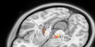 Pensando fuera de la caja: Descubriendo un nuevo enfoque para el monitoreo de ondas cerebrales 