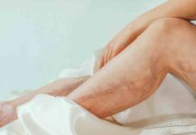 Várices: más que un problema estético, una alerta para la salud Várices: más que un problema estético, una alerta para la salud