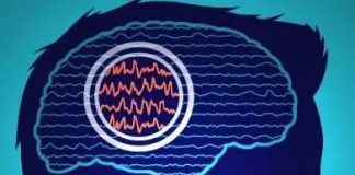 Estudio: La estimulación cerebral profunda personalizada podría tratar la epilepsia resistente a los fármacos