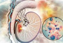 Autoexamen y PET‑CT: dos aliados clave para curar el cáncer testicular Autoexamen y PET‑CT: dos aliados clave para curar el cáncer testicular