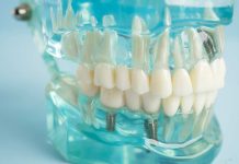 Implantes dentales pueden mejorar la percepción de los chilenos sobre su salud bucal