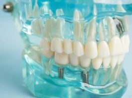 Implantes dentales pueden mejorar la percepción de los chilenos sobre su salud bucal Implantes dentales pueden mejorar la percepción de los chilenos sobre su salud bucal