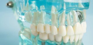 Implantes dentales pueden mejorar la percepción de los chilenos sobre su salud bucal