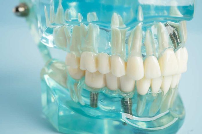 Implantes dentales pueden mejorar la percepción de los chilenos sobre su salud bucal