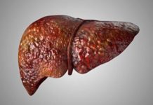 Investigadores de Mayo Clinic asocian mutación hereditaria con enfermedad del hígado graso Investigadores de Mayo Clinic asocian mutación hereditaria con enfermedad del hígado graso