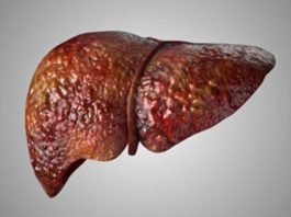 Investigadores de Mayo Clinic asocian mutación hereditaria con enfermedad del hígado graso Investigadores de Mayo Clinic asocian mutación hereditaria con enfermedad del hígado graso