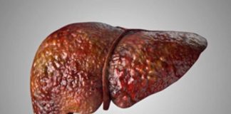 Investigadores de Mayo Clinic asocian mutación hereditaria con enfermedad del hígado graso