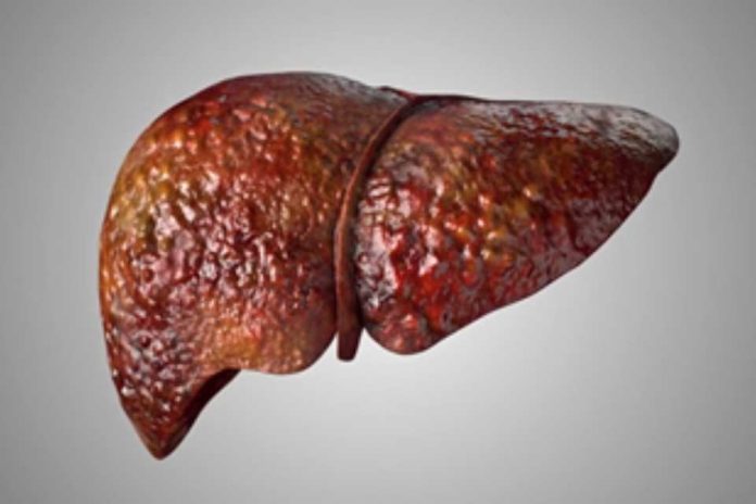 Investigadores de Mayo Clinic asocian mutación hereditaria con enfermedad del hígado graso Investigadores de Mayo Clinic asocian mutación hereditaria con enfermedad del hígado graso