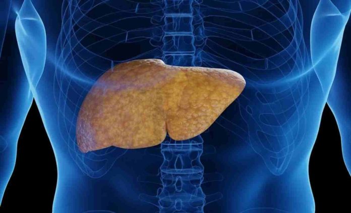 ¡Cuidado con el Hígado Graso! Puede poner en riesgo tu salud ¡Cuidado con el Hígado Graso! Puede poner en riesgo tu salud