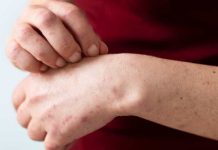 Alerta sanitaria por sarampión: una enfermedad de rápido contagio