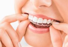 Gracias a la IA tratamientos de brackets invisibles bajan costos y tiempos Gracias a la IA tratamientos de brackets invisibles bajan costos y tiempos