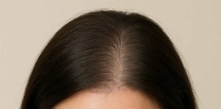 Implante capilar femenino: una solución efectiva y cada vez más natural para la pérdida de cabello