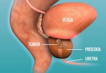 Lutecio-177 PSMA: la opción terapéutica que emerge tras el anuncio del cáncer de próstata de Joe Biden