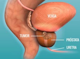 Lutecio-177 PSMA: la opción terapéutica que emerge tras el anuncio del cáncer de próstata de Joe Biden