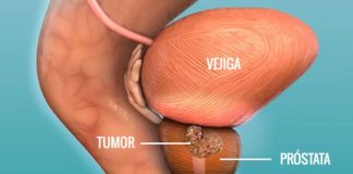 Lutecio-177 PSMA: la opción terapéutica que emerge tras el anuncio del cáncer de próstata de Joe Biden
