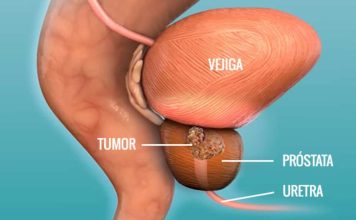 Lutecio-177 PSMA: la opción terapéutica que emerge tras el anuncio del cáncer de próstata de Joe Biden