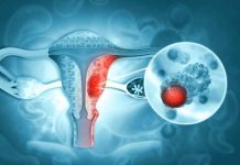 Novedosa terapia de PET‑CT redefine el tratamiento del cáncer de ovario Novedosa terapia de PET‑CT redefine el tratamiento del cáncer de ovario