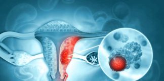 Novedosa terapia de PET‑CT redefine el tratamiento del cáncer de ovario