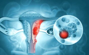 Novedosa terapia de PET‑CT redefine el tratamiento del cáncer de ovario Novedosa terapia de PET‑CT redefine el tratamiento del cáncer de ovario