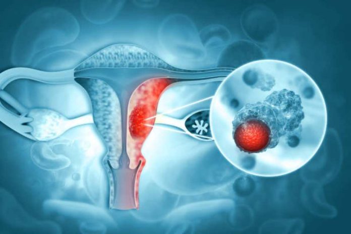 Novedosa terapia de PET‑CT redefine el tratamiento del cáncer de ovario Novedosa terapia de PET‑CT redefine el tratamiento del cáncer de ovario