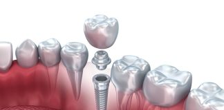 Implantes dentales: nuevas tecnologías subsanan la atrofia del hueso maxilar