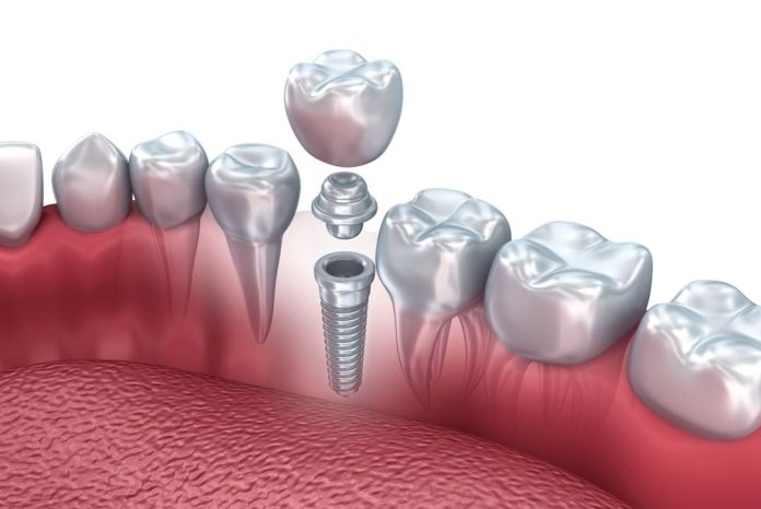 Implantes dentales: nuevas tecnologías subsanan la atrofia del hueso maxilar Implantes dentales: nuevas tecnologías subsanan la atrofia del hueso maxilar