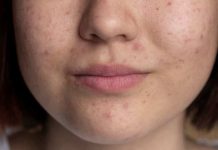 ¿Tienes manchas en la piel? En su día, descubre cómo prevenirlas y tratarlas ¿Tienes manchas en la piel? En su día, descubre cómo prevenirlas y tratarlas