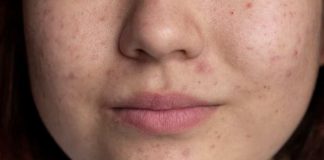 ¿Tienes manchas en la piel? En su día, descubre cómo prevenirlas y tratarlas
