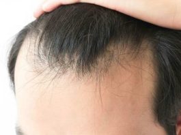 Alopecia masculina: sí podría ser reversible Alopecia masculina: sí podría ser reversible