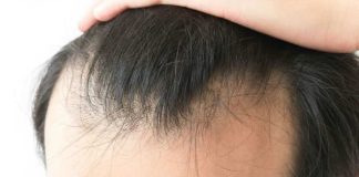 Alopecia masculina: sí podría ser reversible