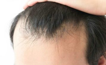 Alopecia masculina: sí podría ser reversible Alopecia masculina: sí podría ser reversible