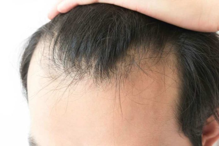 Alopecia masculina: sí podría ser reversible