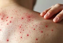 “Es altamente contagiosa y puede ser mortal”: Experto alerta riesgos del sarampión en medio de baja vacunación infantil “Es altamente contagiosa y puede ser mortal”: Experto alerta riesgos del sarampión en medio de baja vacunación infantil