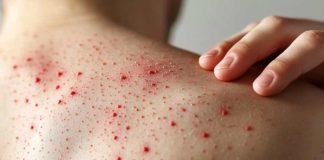 “Es altamente contagiosa y puede ser mortal”: Experto alerta riesgos del sarampión en medio de baja vacunación infantil