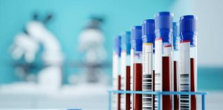 Exámenes claves para detectar trastornos en la sangre y evitar enfermedades como la anemia y leucemia