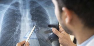 Mayo Clinic en Arizona anuncia el lanzamiento de un nuevo programa de trasplante de pulmón